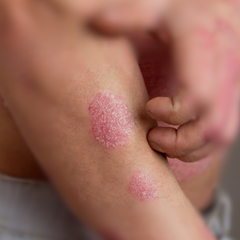 Collection image for: Psoriasis
