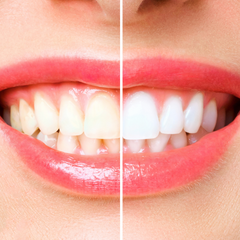 Collection image for: Teeth Whiteners